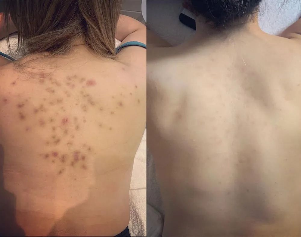 كورس بيرليا جلوتاثيون 3000mg لتوحيد لون الجسم والمناطق الحساسة