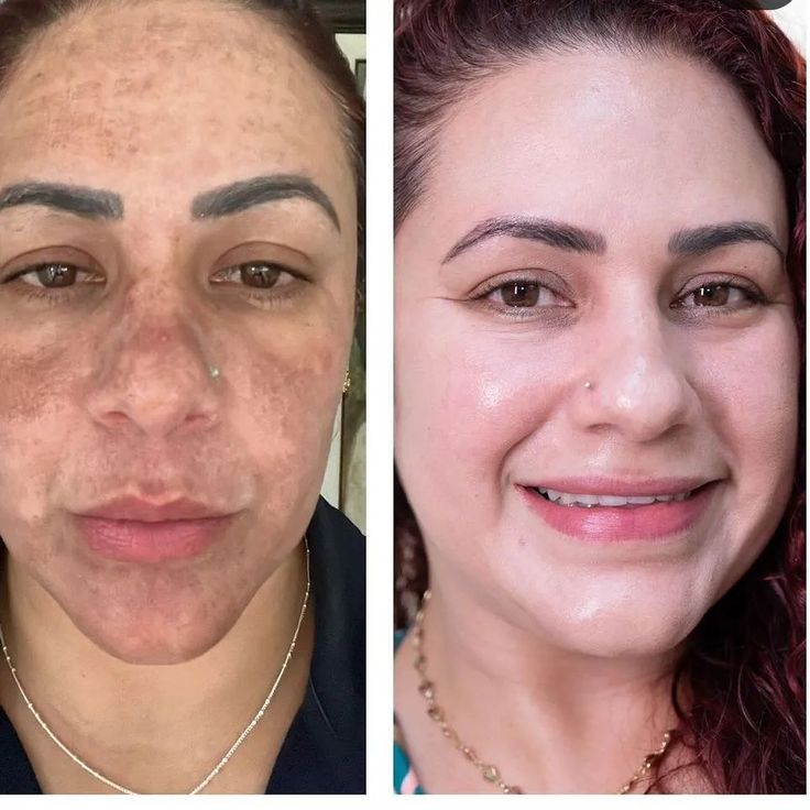 كورس بيرليا جلوتاثيون 3000mg لتوحيد لون الجسم والمناطق الحساسة
